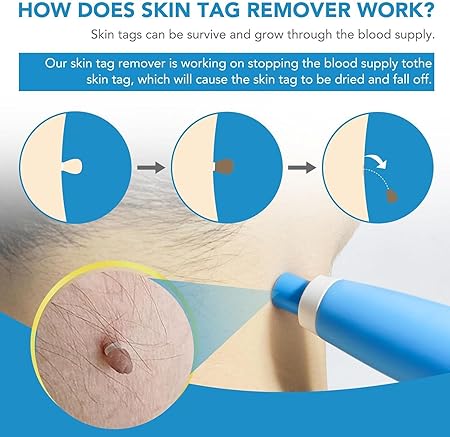 Skin Tag Removal Kit 2-in-1 | Complete Home Care Set with Cleaning Wipes